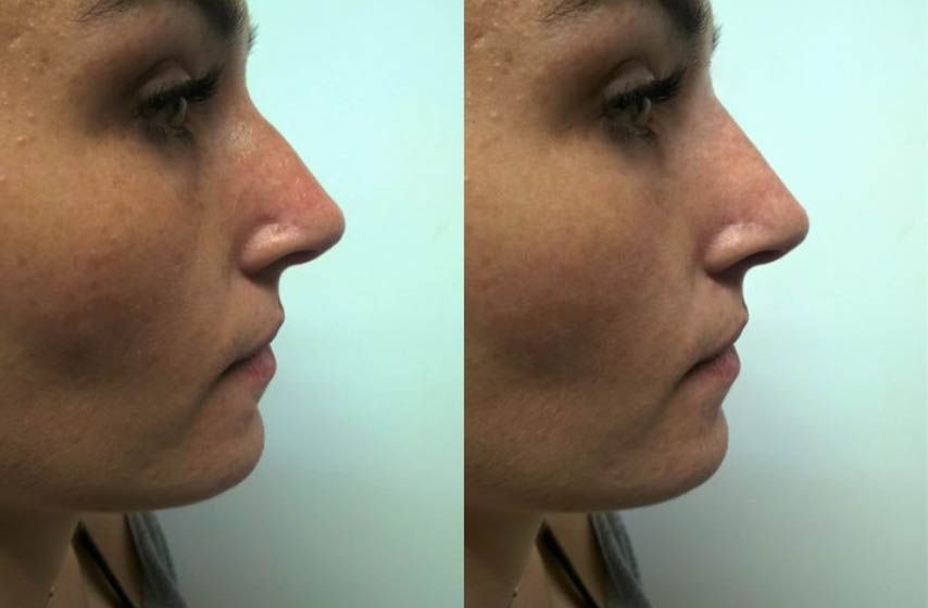 korigovanje nosa, estetska hirurgija